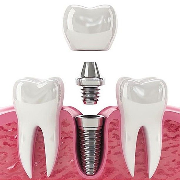 Implant Dentistry Equipment